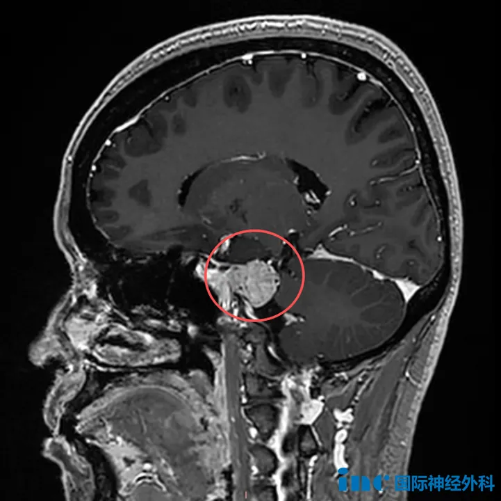 为何脑膜瘤总是体检被发现!?会不会长大?多项研究揭示脑膜瘤生长速度