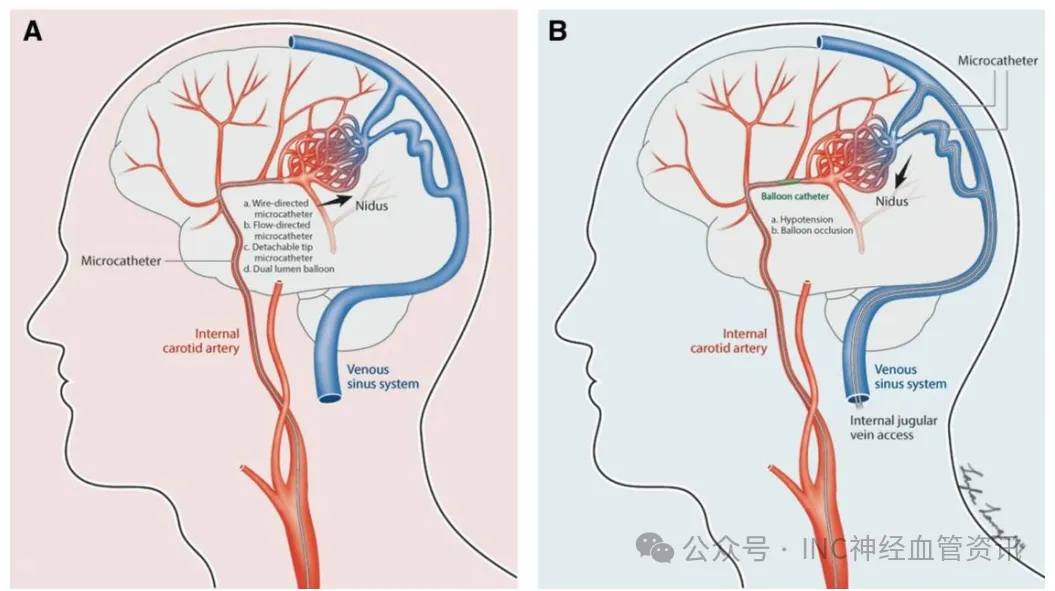 颅内动静脉畸形经动脉（A）与经静脉（B）两种治疗入路的对比示意图