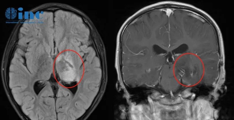 胚胎发育不良性神经上皮瘤