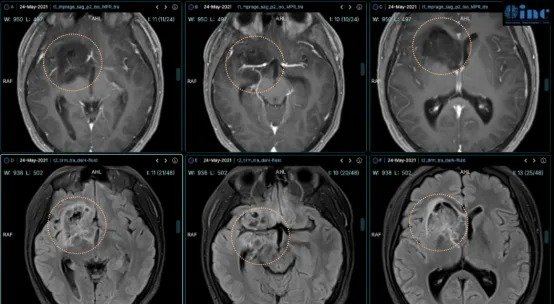 巨大基底节区DNET