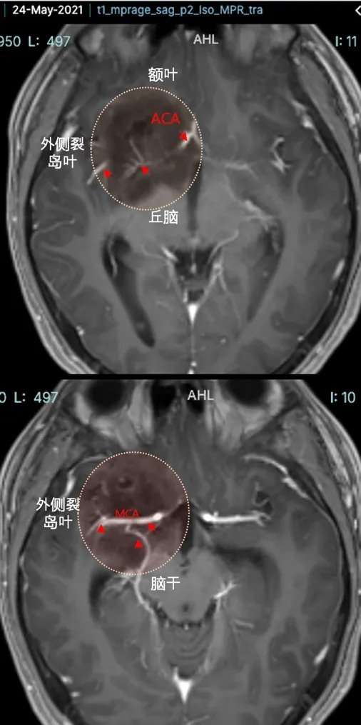 巨大基底节区DNET