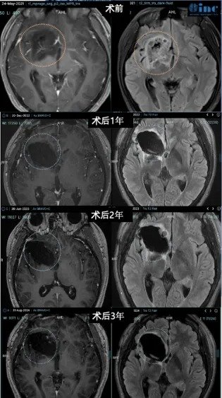 术后3年复查无复发