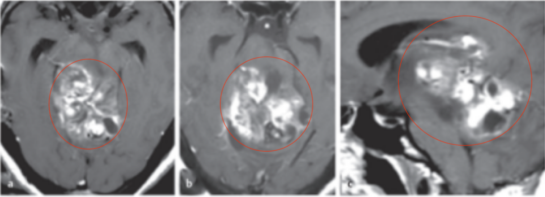 图:术前MR检查,轴位、矢状位MR显示巨大脑干肿瘤占位,信号不一,从中脑两侧延伸压迫到丘脑、脑桥和小脑。