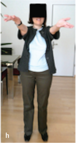 脑干胶质瘤案例