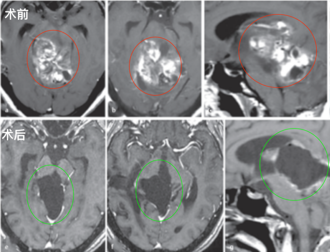 图:术前术后脑磁共振对比,巨大脑干胶质瘤全切,无神经脑组织损伤。