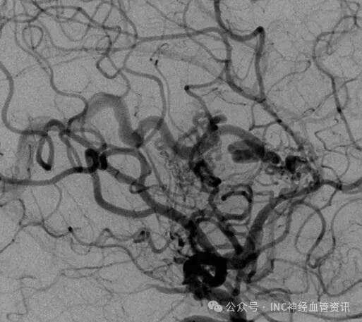 该AVM由ACA/PcaA分支、ACoA穿支和mPChA供血[右侧ICA造影