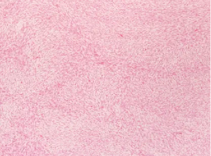 病理标本染色显示高细胞密度、双相性肿瘤，上皮样细胞与梭形细胞成分呈束状排列。苏木精-伊红（H&E）染色，原始放大倍数×30。