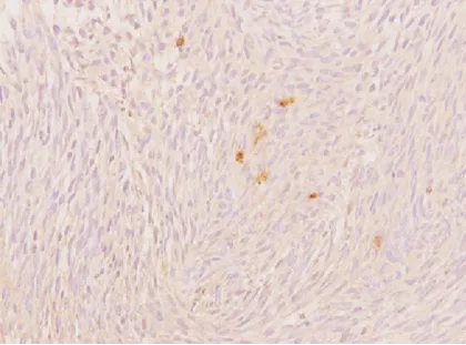 S100蛋白弥漫阳性免疫组织化学染色。原始放大倍数×200。