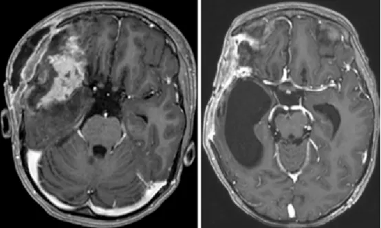 图4.左图：开颅术后第1天获取的轴位T1加权钆增强MR图像，显示肿瘤次全切除术后改变及周围脑软化。