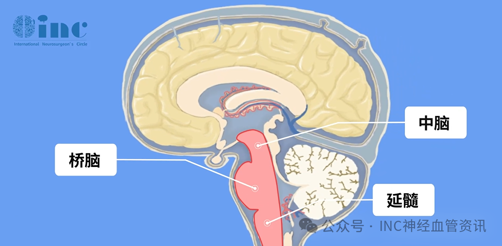 脑干海绵状血管瘤为何易出血?4 大高危因素深度解析