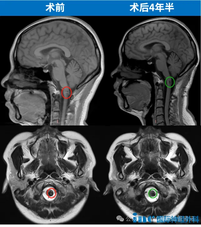 延髓海绵状血管瘤