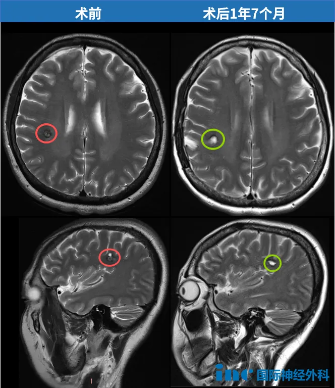 海绵状血管瘤影像