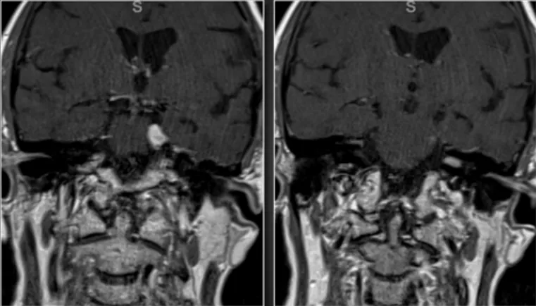 颅内两处肿瘤，为何只需一次手术？术后5天顺利出院又是如何实现的？
