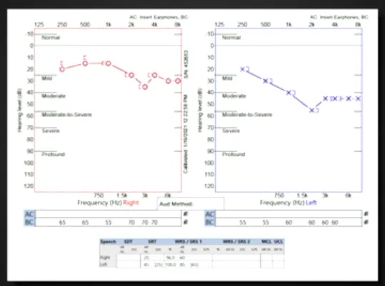 （术后听力图）