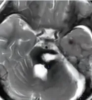 巴教授手术清除，结构完整