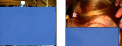 巴教授手术清除，结构完整