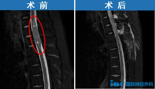 2型神经纤维瘤病影像