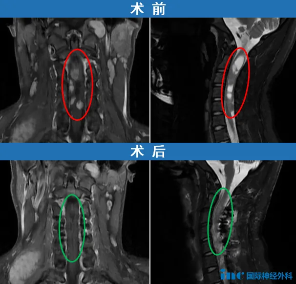 2型神经纤维瘤病影像