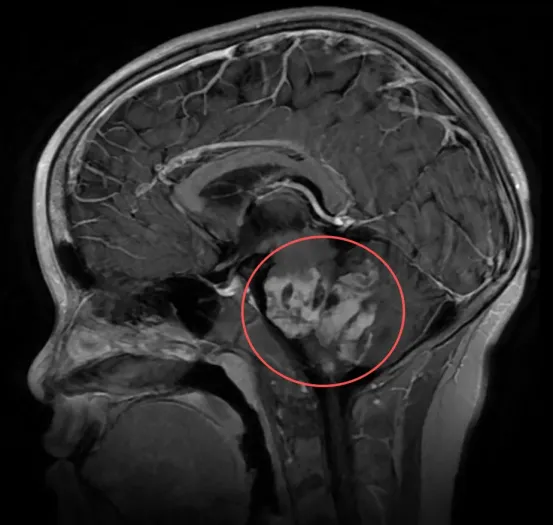 儿童弥漫性星形细胞瘤（WHO 2级）