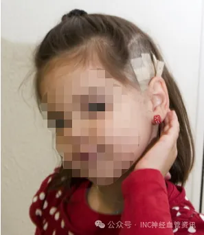 脑干海绵状血管瘤案例