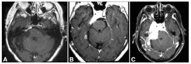 图1.56岁女性患者，曾接受右侧蝶岩斜区脑膜瘤切除术，磁共振影像显示肿瘤进展