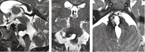 脑干海绵状血管瘤二次出血