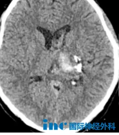 左侧丘脑脑出血伴脑室内积血