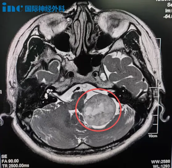 桥小脑角区占位