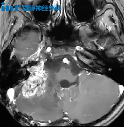 儿童脑瘤小勇士影像