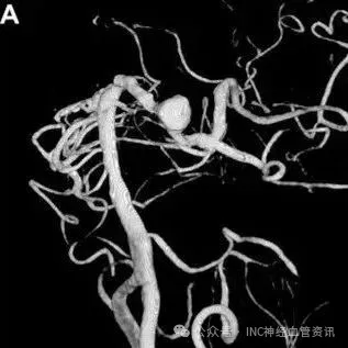 囊状动脉瘤与梭形动脉瘤图示
