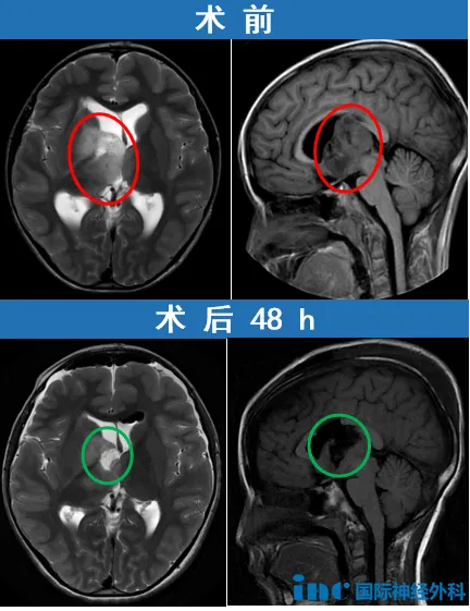 巴教授随访报告截取