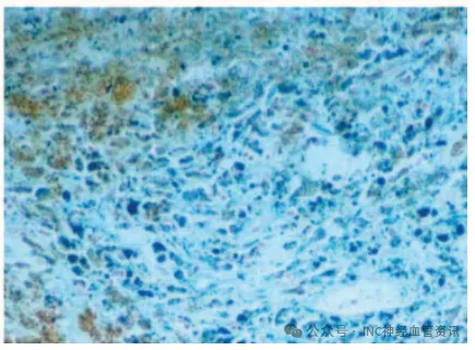 40 gy放射治疗后的丘脑海绵状血管瘤组织样本
