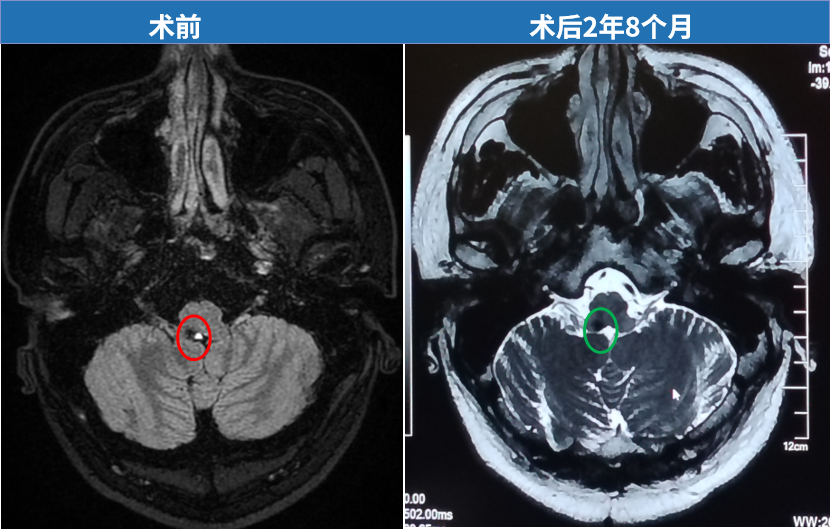 脑干延髓海绵状血管瘤影像