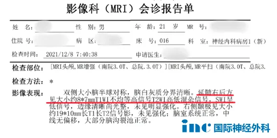 脑干延髓海绵状血管瘤诊断