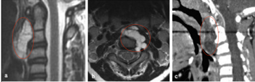 【图2（a）术前MR及CT显示，C1-3占位，提示嵴索瘤可能】