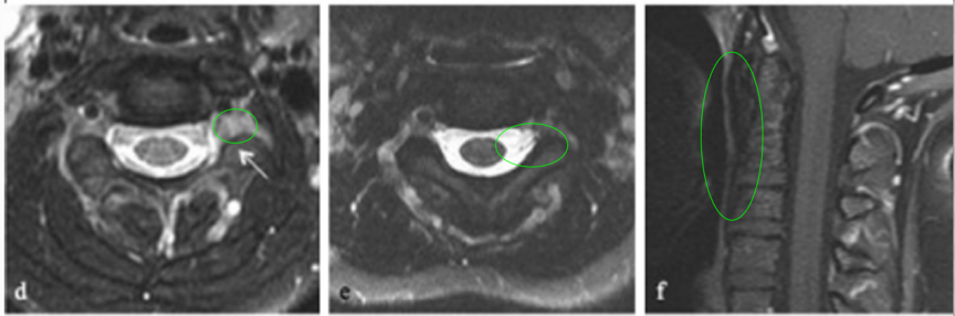 【图3术后MR显示肿瘤切除达95%以上，C2-C3神经孔内有小残留肿瘤（d，如箭头所示）】