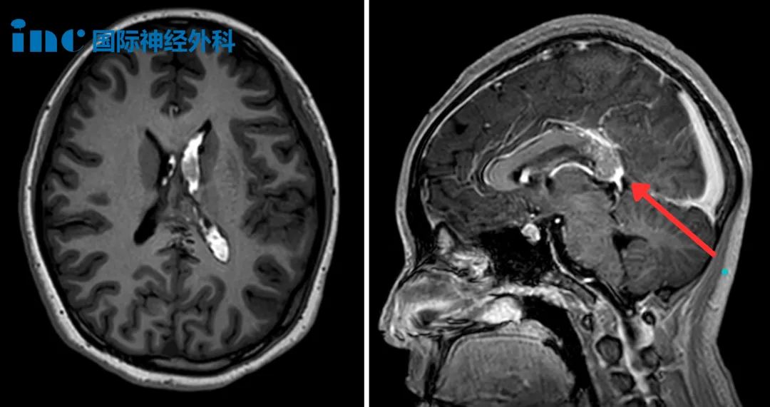 随访捷报！15岁高难度脑动静脉畸形患者术后半年复查：“切除率100%，我认为不会再复发！”