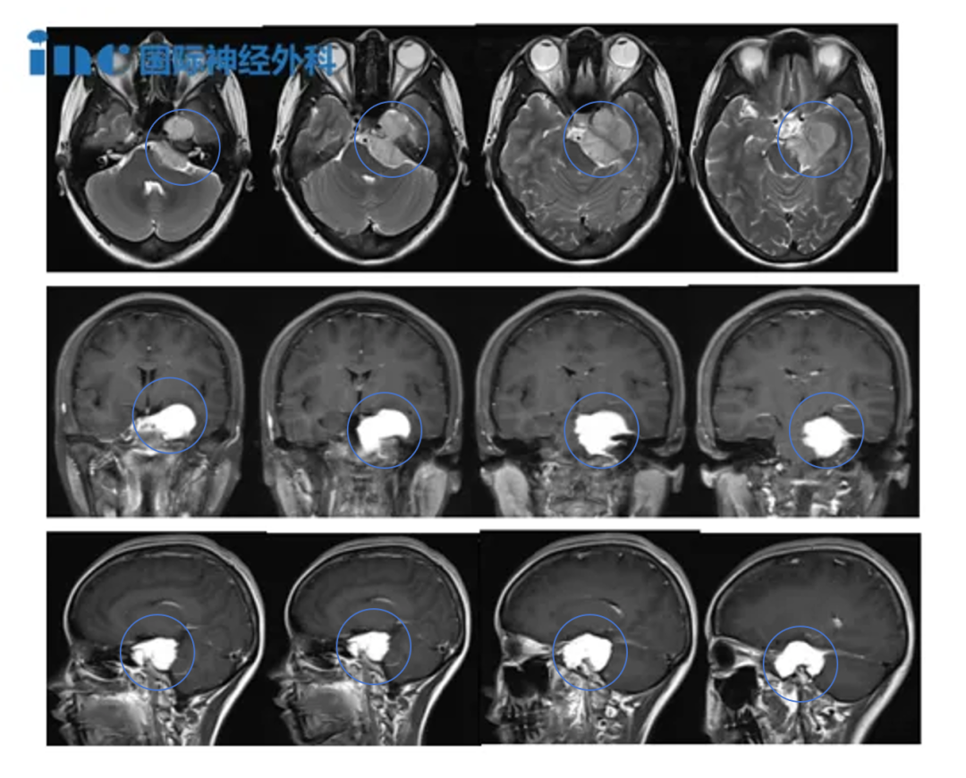 案例一：体检发现的4cm脑膜瘤