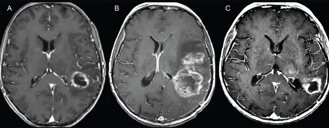 图1.假性进展典型病例