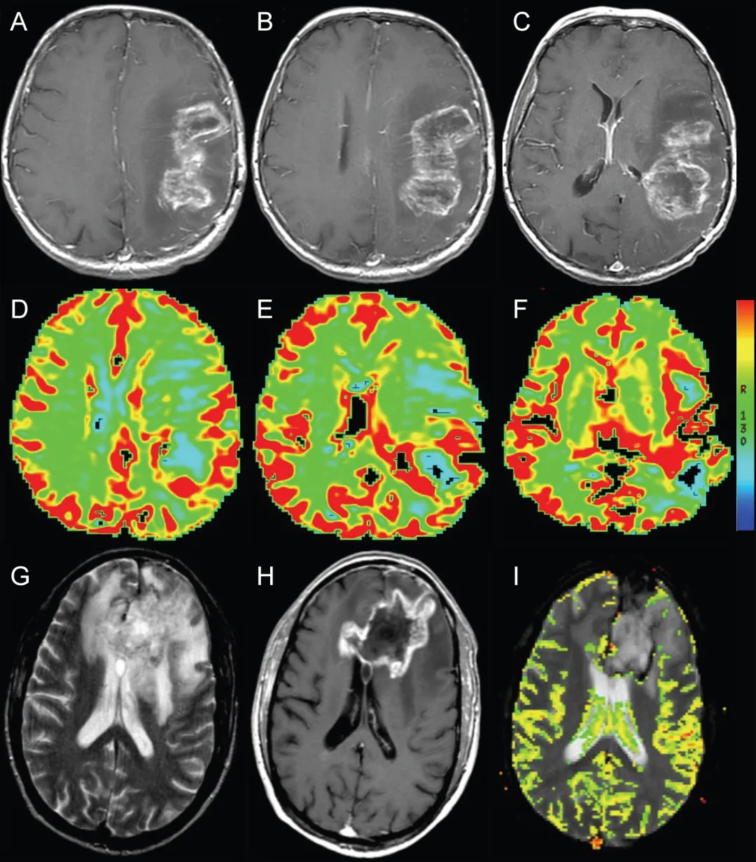 图2.动态磁敏感对比灌注成像辅助鉴别假性进展