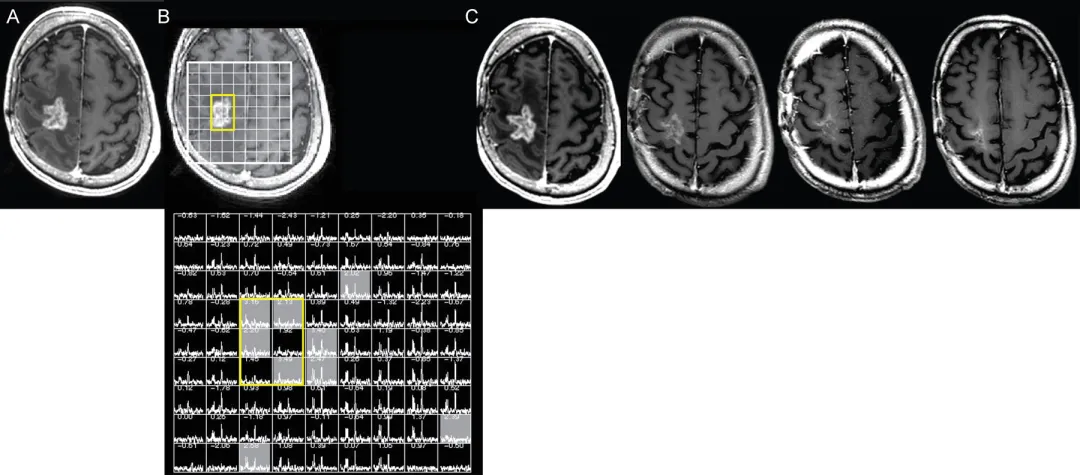 图4.磁共振波谱辅助判定假性进展