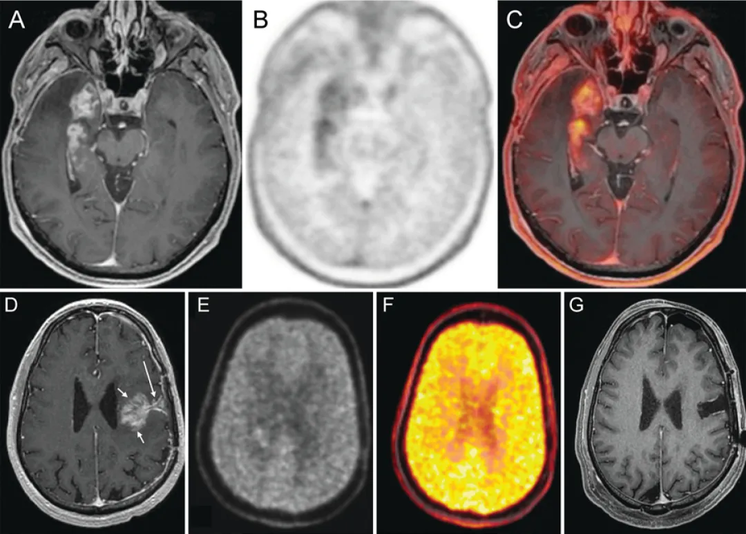 图5.PET在复发判断中的应用案例