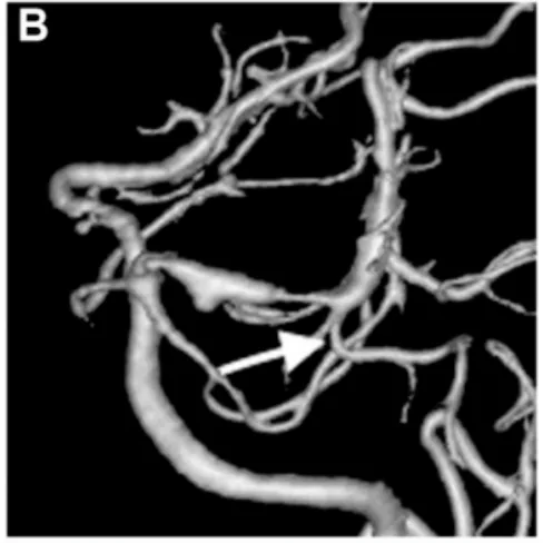 出血后18天血管造影显示左侧P1-P2段扩张伴狭窄特征，颞后动脉自狭窄病变远端发出（箭头标注）
