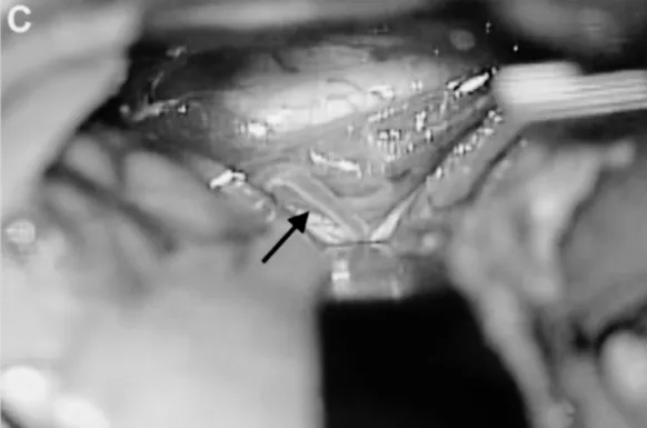 C、D.选择颞后动脉（箭头标注）作为受体动脉，经左侧颞下入路用连续缝合行颞浅动脉-颞后动脉吻合；