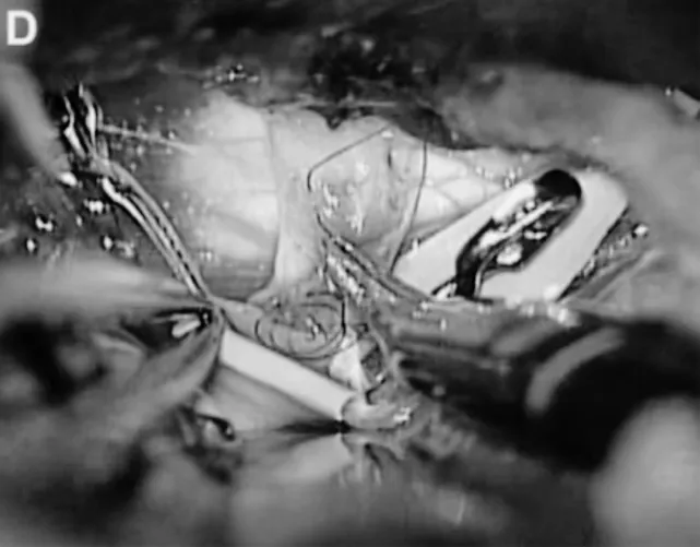 C、D.选择颞后动脉（箭头标注）作为受体动脉，经左侧颞下入路用连续缝合行颞浅动脉-颞后动脉吻合；