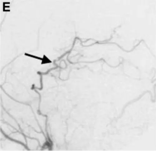 术后1周颈外动脉血管造影显示，通过分流血管，整个左侧大脑后动脉供血区血流良好（箭头标注）。
