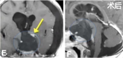 儿童胶质瘤影像