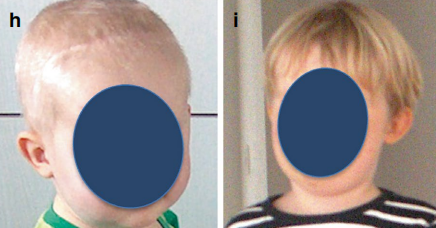 图：术后1个月（图H）及2年（图I）复查显示，患儿临床状态优良。