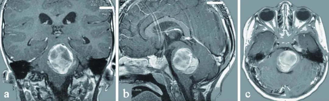 图a-c为术前影像