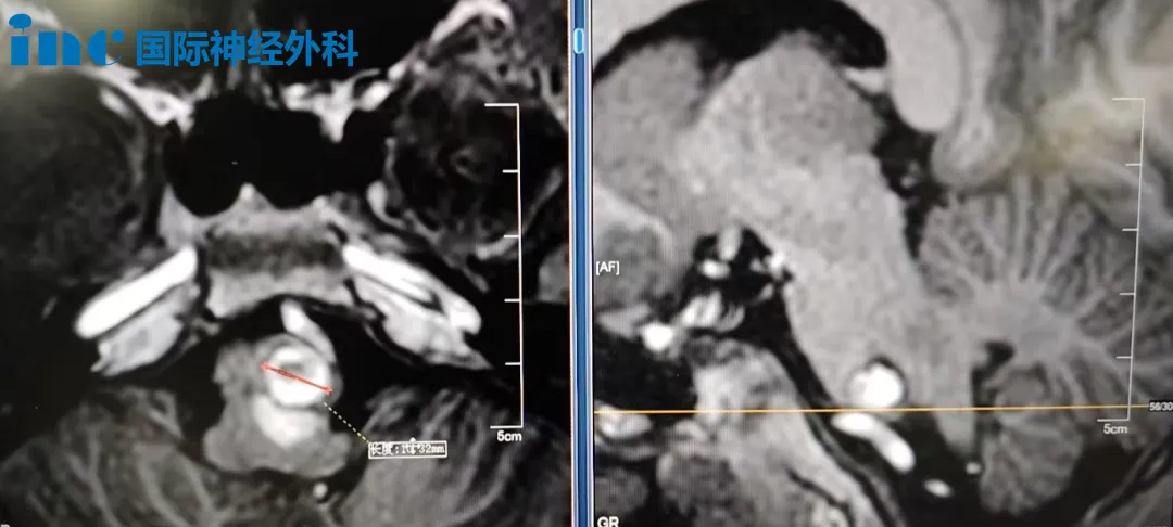 脑干海绵状血管瘤影像